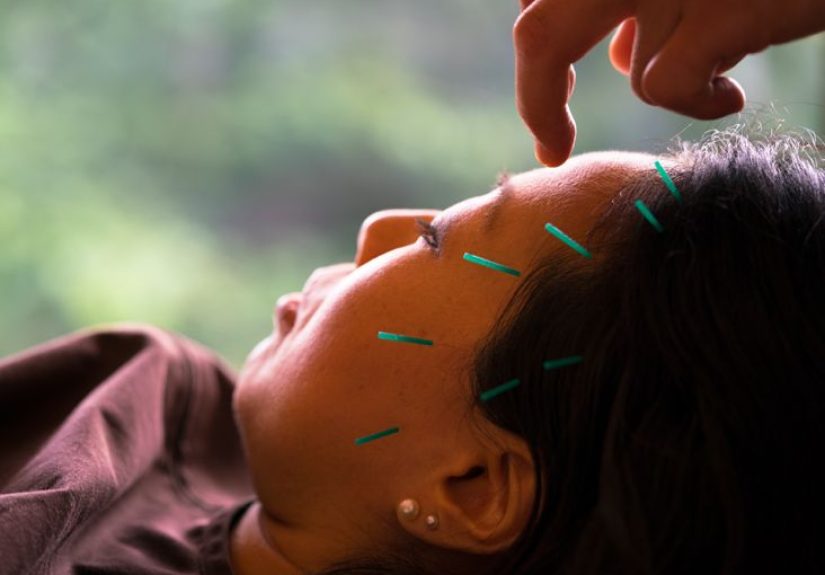 Acupuncture for Sleep: Get the Best Treatment for Your Best Zzz’s