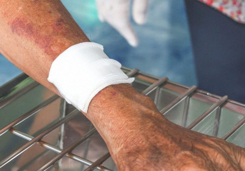 Blood Clot in Arm: Symptoms, Treatment, and Prevention