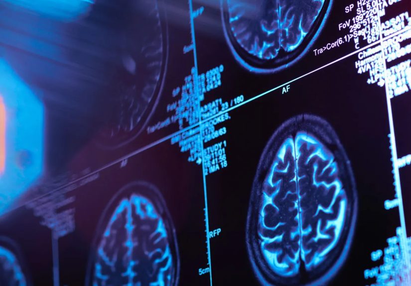 New Research Forecasts Dementia Cases in United States Will Double by 2050