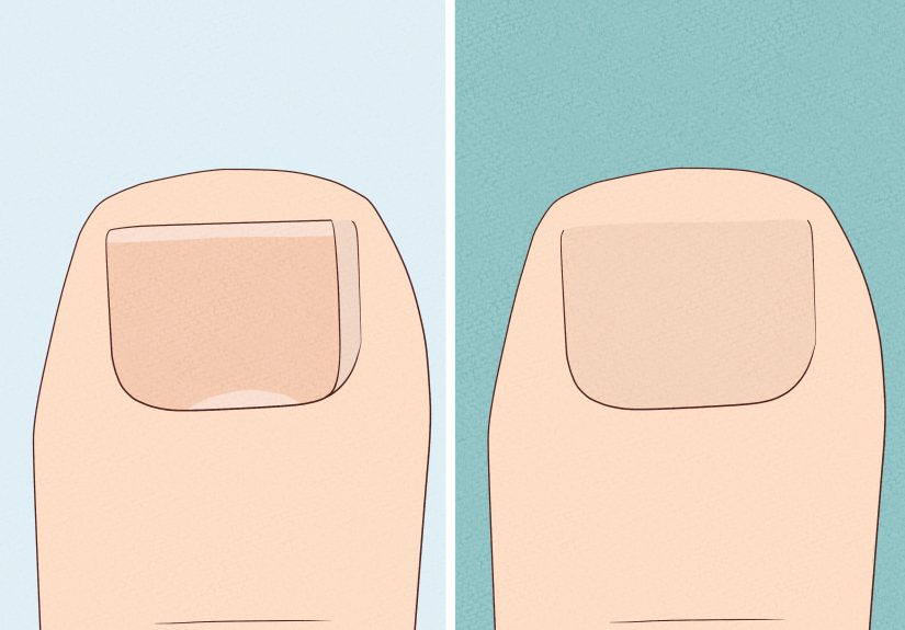 3 Ways to Heal an Ingrown Toenail