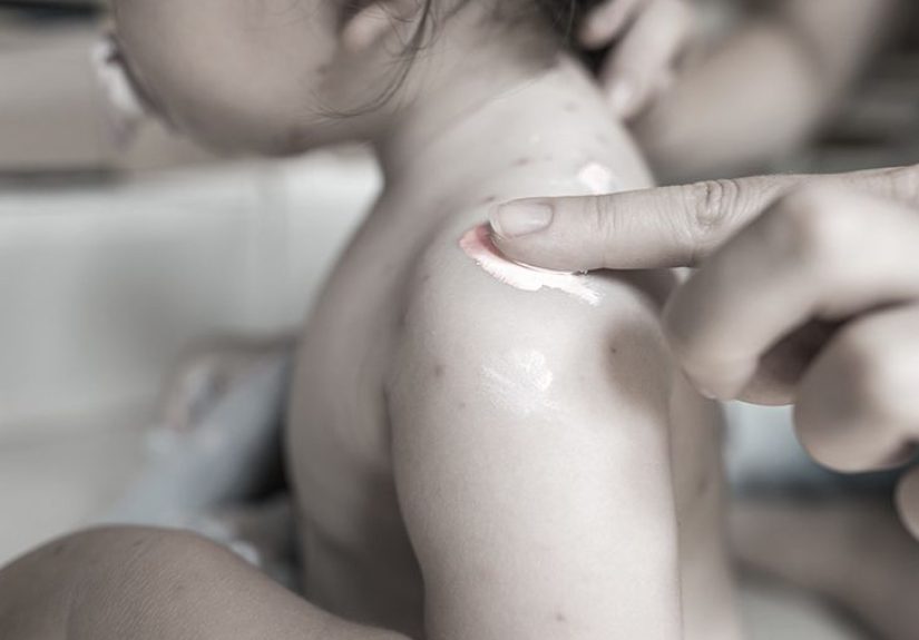Calamine lotion uses: How to use for sunburn, acne, and more
