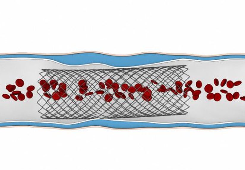 Drug-Eluting Stents: How Do They Work?