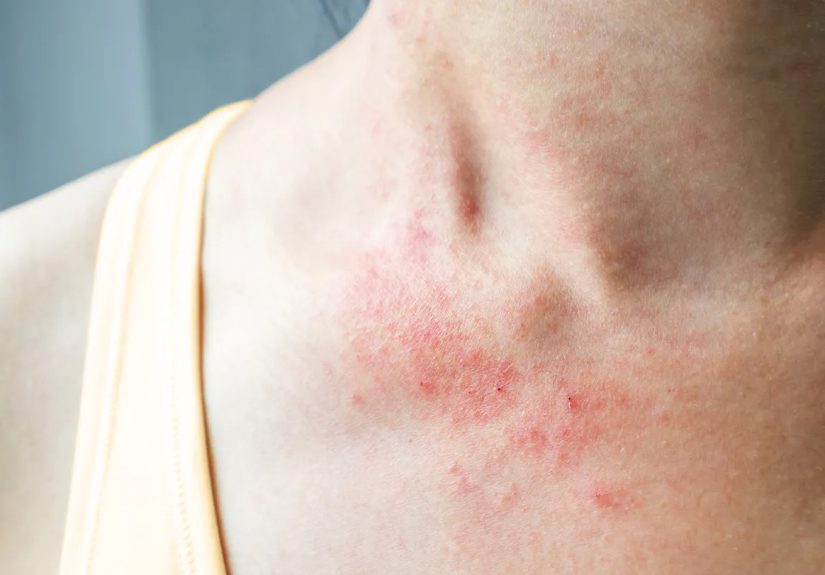Eczema May Raise Eating Disorder Risk