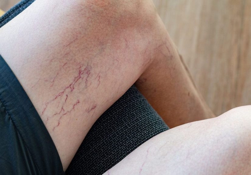How to Get Rid of Spider Veins: Professional and Home Treatment