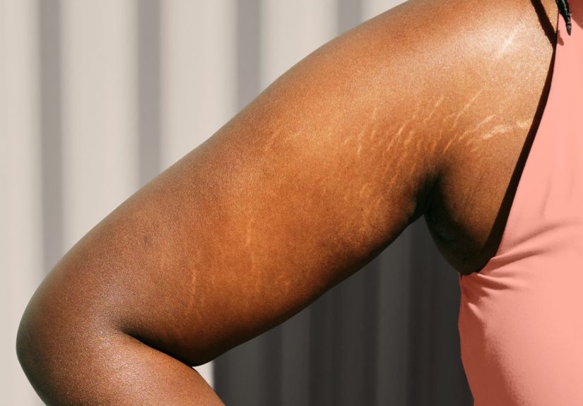 Stretch Marks: Why They Happen and How to Get Rid of Them