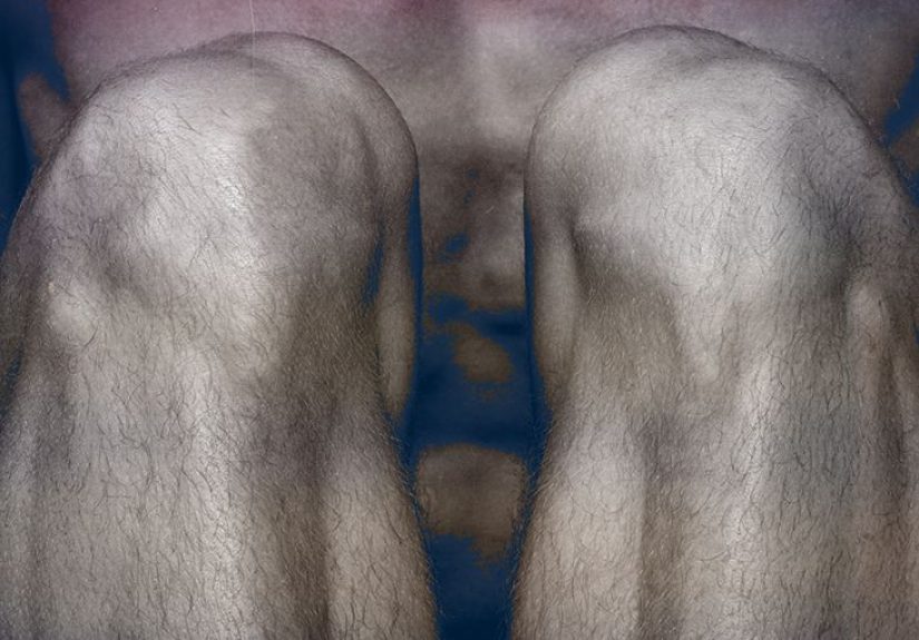 Tricompartmental osteoarthritis: What you need to know