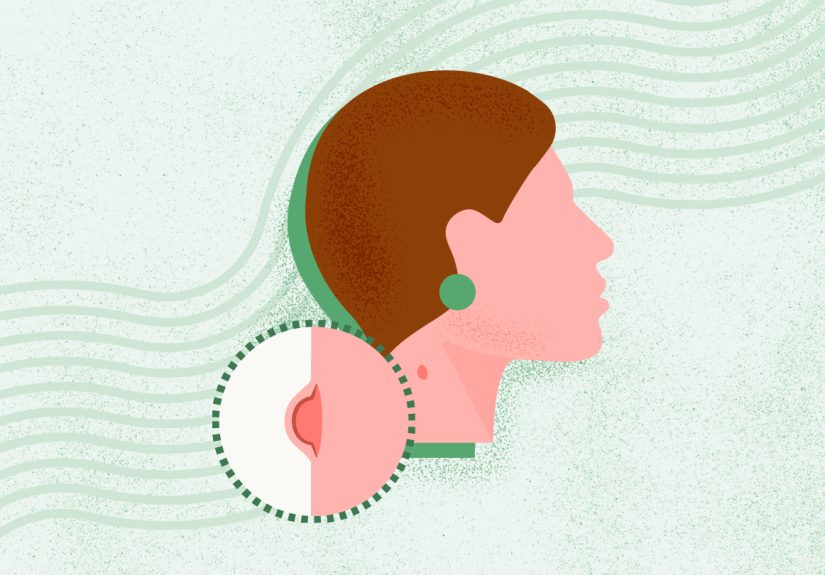 Acne: Symptoms, Causes, Diagnosis, Treatment, and Prevention