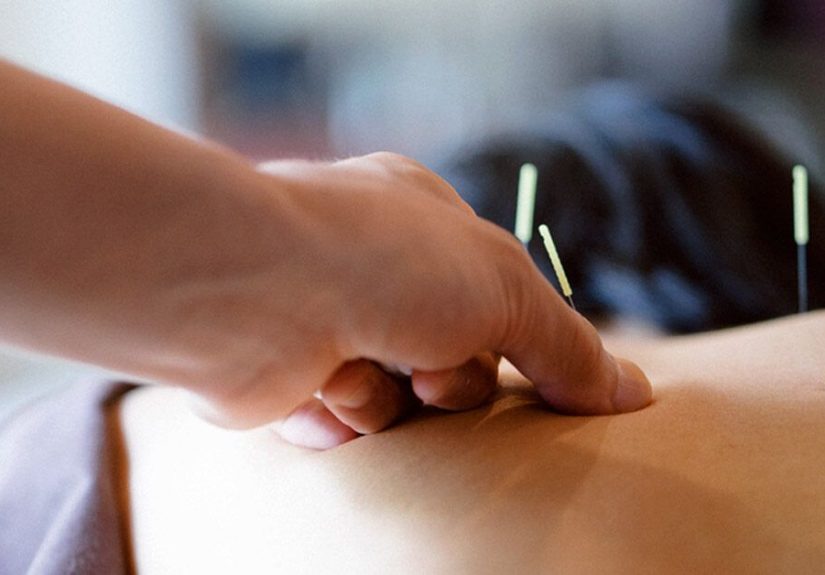 Acupuncture for Weight Loss: Does It Work?