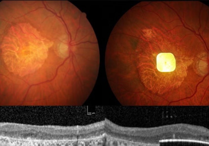 Aging: Eye implant restores vision loss from irreversible condition