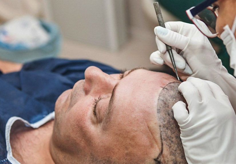 Hair Transplant Scar: Is It Permanent or Can It Be Removed?
