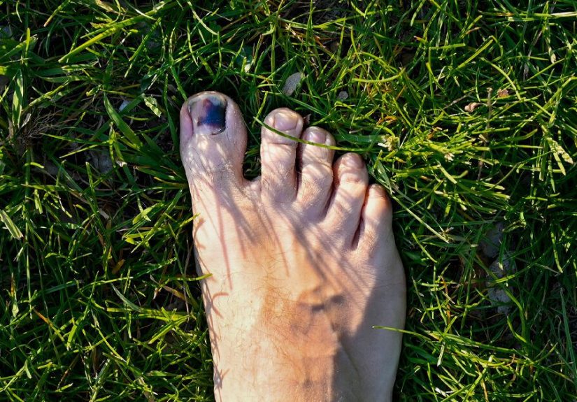 How Long Does It Take for a Toenail to Grow Back?