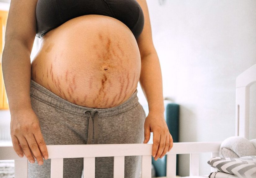 Itchy Belly Button During Pregnancy: Causes and Treatment