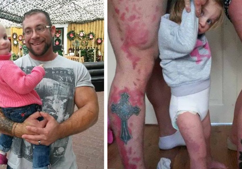 Parents Tattoo Their Legs With Daughter’s Birthmark So She Won’t Feel Different