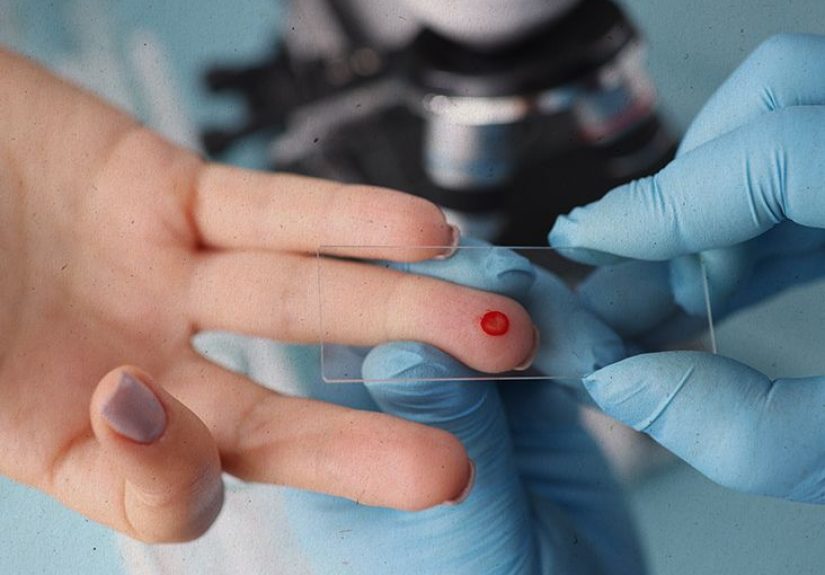 Poikilocytosis: Types, Symptoms, and Treatment