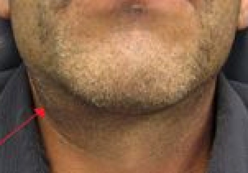 Salivary Duct Stones: Causes, Symptoms, and Diagnosis