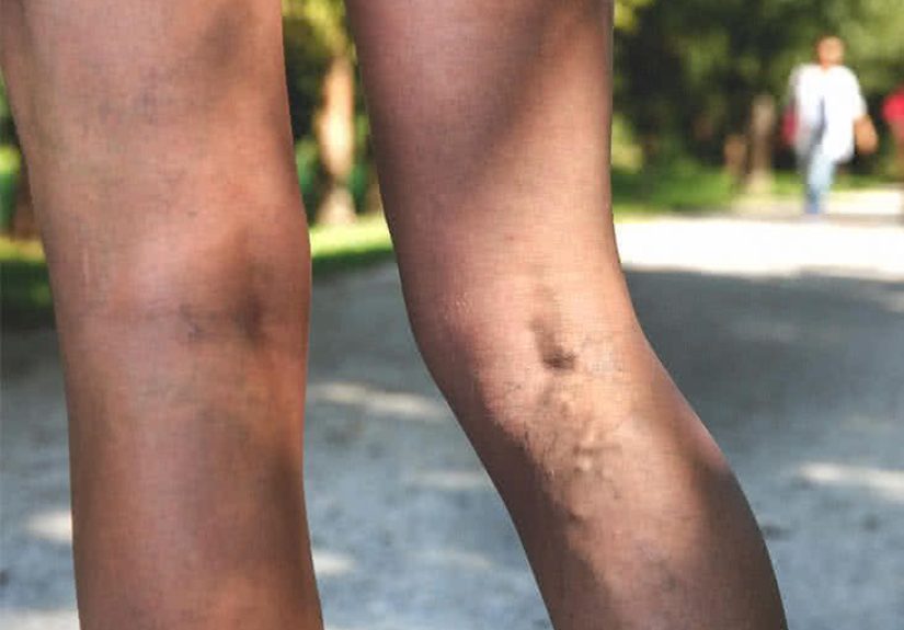 Varicose Vein Pain: What It Feels Like and Relief