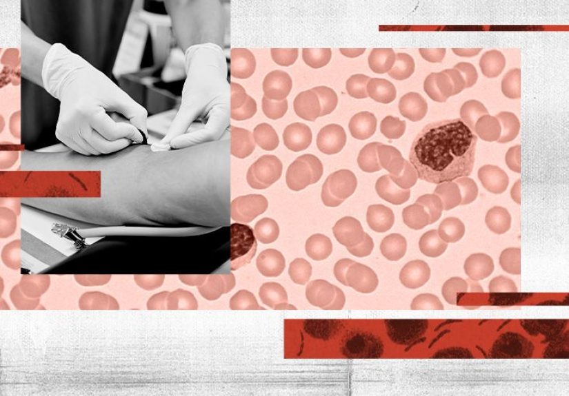 What causes a low platelet count (Thrombocytopenia)?