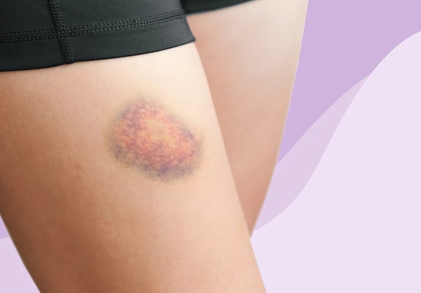 Hepatitis C Skin Conditions