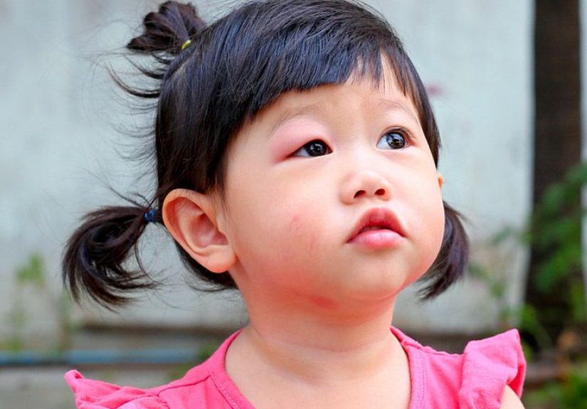 Infected Eye: 8 Common Causes