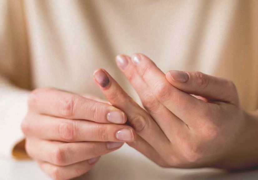 Smashed Finger: Treatment, Recovery, Seeking Help, and More